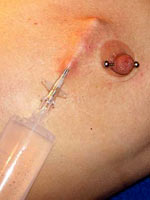 Saline injection in breasts